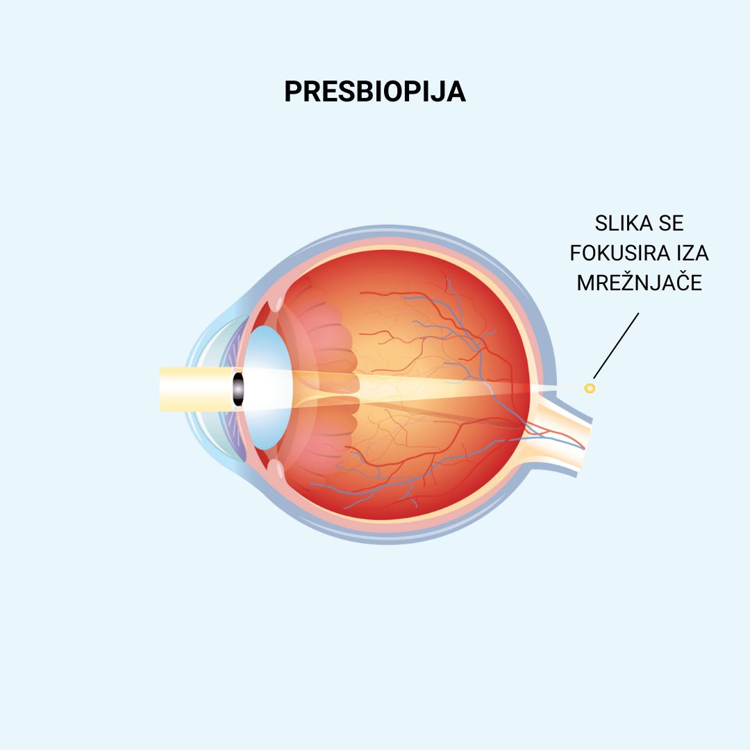 Staracka dalekovidost ili naocare za citanje