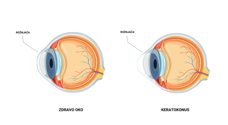 Roznjaca kod keratokonusa i zdravog oka